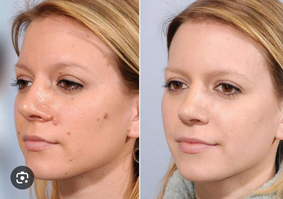 Conquer Skin Imperfections with Ease: Your Guide to At-Home Skin Tag Removal
